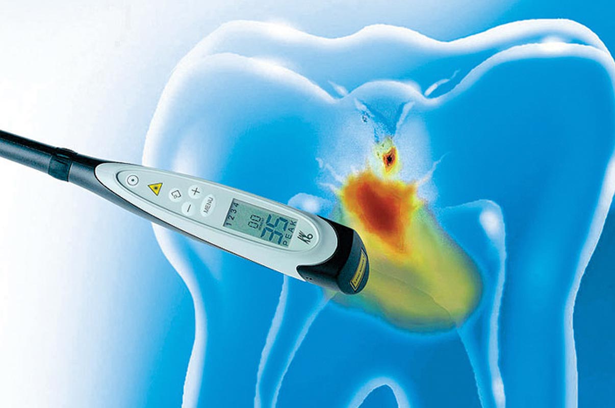 Laser per diagnosi carie